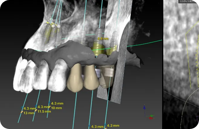 インプラントシミュレーション用PCソフト